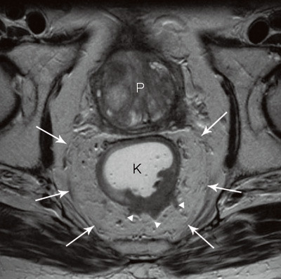 Figur 4  H&oslash;yoppl&oslash;selig MR-bilde av rectumcancer, perpendikul&aelig;rt p&aring; tumors lengdeakse. Den mesorektale fascie identifiseres&hellip;