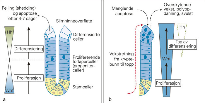 Figur 2  Normal og neoplastisk utvikling i tykktarmens krypter.a) Normal vekst og differensiering i colonkrypt, fra basale&hellip;