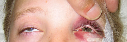 Figur 2  Restriksjon av &oslash;yebevegelighet oppover p&aring; venstre side