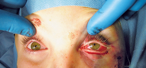 Figur 4  Etter rekonstruksjon av orbitagulvet