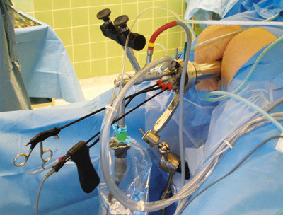 Figur 3  Utstyret til transanal endoskopisk mikrokirurgi montert ved en operasjon