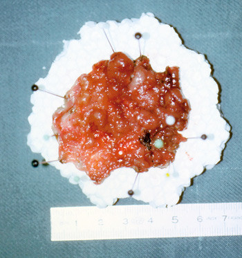 Figur 5  Et flatt adenom i rectum resecert ved transanal endoskopisk mikrokirurgi