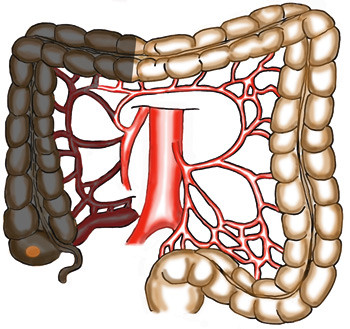 Figur 2  Tumor i coecum/ascendens: H&oslash;yresidig hemikolektomi. Kar settes av inne ved a. mesenterica superior-karene