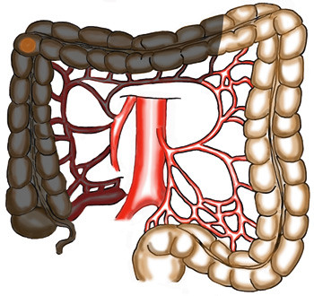 Figur 3  Tumor i h&oslash;yre fleksur: Utvidet h&oslash;yresidig hemikolektomi. Karene, inklusive a. colica media, settes av ved a&hellip;