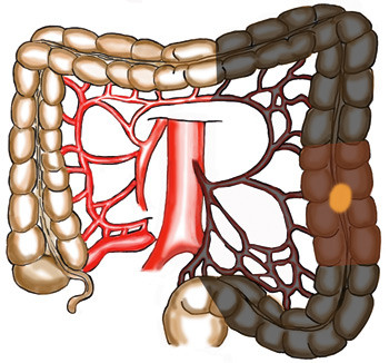 Figur 6  Tumor i descendens: Venstresidig hemikolektomi