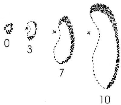 Figur 5  Lashleys klassiske beskrivelse av homonymt flimmerskotom under eget migreneanfall. Ved tid 0 fikk han flimring i&hellip;