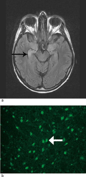 Figur 2  a) MR(FLAIR)-bilder av hjernen hos pasient 1 viste h&oslash;ysignalopptak i mediale deler av h&oslash;yre hippocampus, forenlig&hellip;