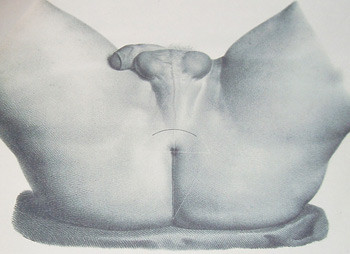Figur 2  Inngrepet innledes ved at et halvm&aring;neformet snitt legges i perineum. Illustrasjonen er av den franske kirurgen&hellip;
