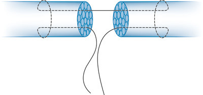 Figur 2  Eksempel p&aring; suturteknikk ved seneskade
