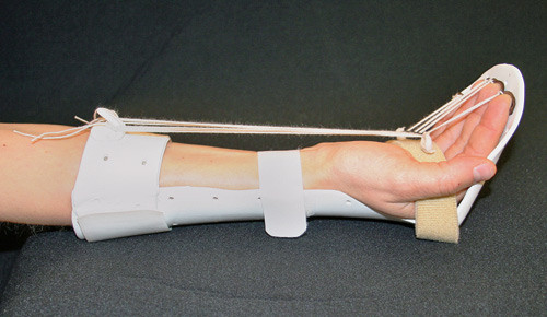 Figur 3  Kleinert-skinne med strikker tilpasset &oslash;velser med aktiv ekstensjon av fingeren og passiv fleksjon for opptrening&hellip;