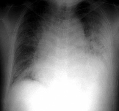 Figur 2  R&oslash;ntgen thorax ved innkomst p&aring; sykehuset viste en forst&oslash;rret hjerteskygge og forandringer forenlig med lungestuvning