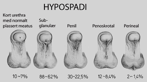 Figur 2  Hypospadityper &ndash; prosentvis fordeling (12). Gjengitt med tillatelse