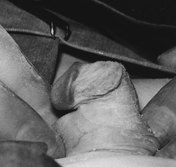 Figur 3  Ventral krumning av penis (chorda) (12). Gjengitt med tillatelse