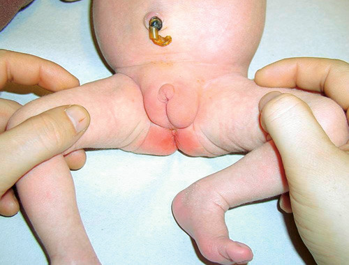 Figur 5  Nyf&ouml;tt barn med 46,XY karyotyp, diagnosticerad med partiell androgeninsensitivitessyndrom. Barnet hade en palpabel&hellip;