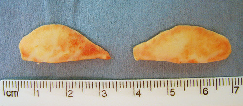 Figur 2  Tarsalplater