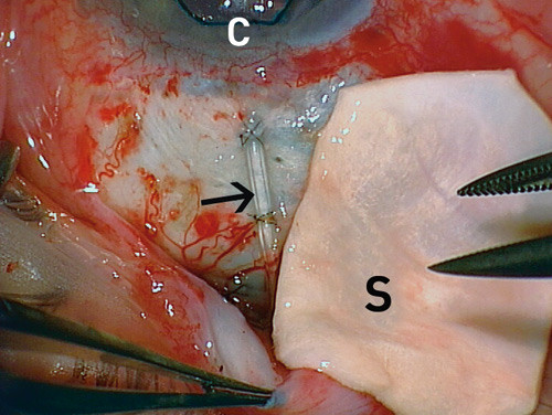 Figur 3  Glaukomoperasjon med implantering av ventil. Skleraltransplantat (S) skal legges over en ventilslange (pil). &Oslash;verst&hellip;
