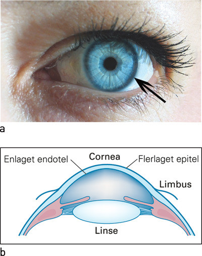 Figur 4  a) Hornhinnens epitellag har stamceller som befinner seg i 360&deg; ved limbus (pil). b) Tverrsnitt av fremre del av&hellip;