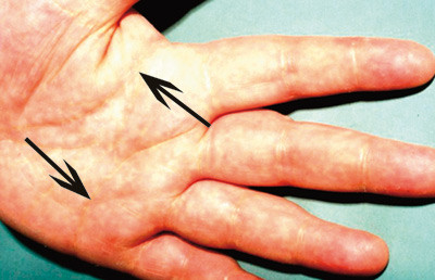 Figur 4  Gule furer i hendene (piler). Disse er fylt av skumceller og er karakteristiske for type 3-hyperlipidemi. Foto Leiv&hellip;