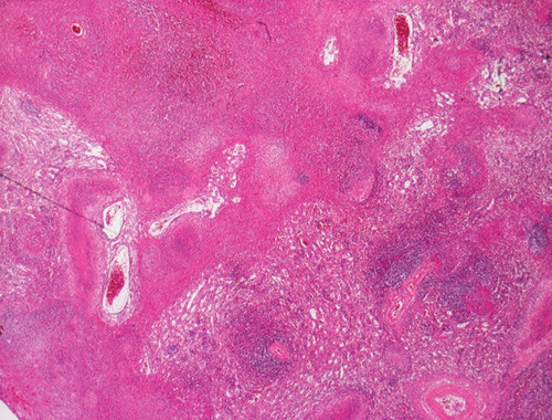 Figur 2  Hematoksylin-eosin-farget biopsi fra milt (2x) som viser iskemisk nekrose med granulocyt&aelig;r demarkering i randsonen