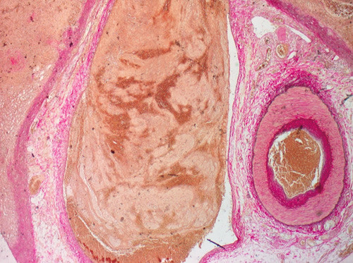 Figur 3  Elastica-van Gieson-farget biopsi fra milt (2x) som viser sekund&aelig;r trombotisk vene (til venstre) og normal arterie &hellip;