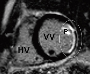 Figur 2  Til sammenlikning med myokardittforandringene i figur 1 vises forandringer etter et lateralt myokardinfarkt (sirkel&hellip;