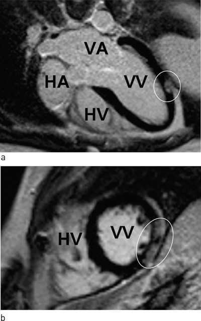 Figur 3  Figurene viser MR-funn hos en mann i 50-&aring;rene med akutt myokarditt etter en tre ukers periode med&hellip;