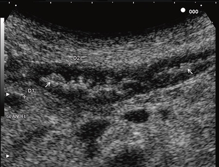Figur 3  Transabdominal ultralyd av tynntarmen f&oslash;r behandlingen startet. Tarmveggen m&aring;les til 4,7 mm, mucosa og submucosa er&hellip;