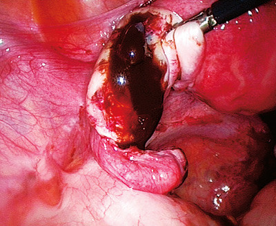 Figur 2  Rumpert endometriosecyste