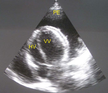 Figur 2  Apikalt firekammerbilde. Tuberkul&oslash;s perikarditt hos hivpositiv mann 41 &aring;r. Sv&aelig;r perikardeffusjon (PE) med&hellip;