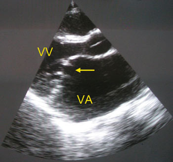 Figur 4  Parasternal langakse av samme pasient (fig 3). Mitral stenose/insuffisiens med under 1 cm &aring;pning mellom stive&hellip;