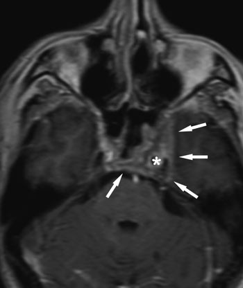 Figur 2  T₁-vektet MR caput med gadolinium i aksialt plan. Sparsom kontrastoppladning i en oppfylling i sinus cavernosus &hellip;