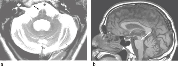 Figur 2  a) Aksial T2-vektet MR av nedre del av pons hos pasient med multippel systematrofi. Karakteristisk h&oslash;ysignalkors&hellip;