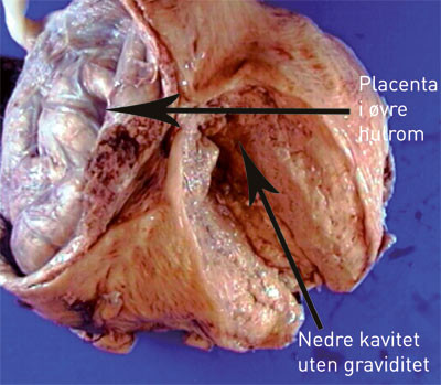 Figur 2  Operasjonspreparatet (uten foster) med placenta in situ etter formalinbehandling