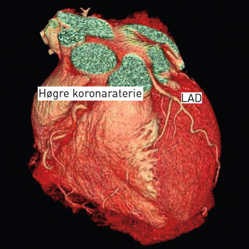 Figur 2  Eksempel fr&aring; 16-detektor-CT-unders&oslash;king. 3D-bilete laga p&aring; CT-arbeidsstasjon med framstilling av hjartet og delar&hellip;