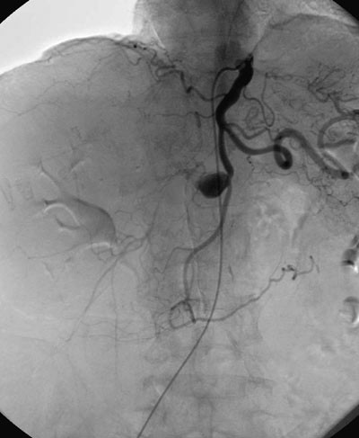 Figur 2  Digital subtraksjonsangiografi som viser &aring;pen truncus coeliacus, a. hepatica communis og a. gastroduodenalis. Like&hellip;