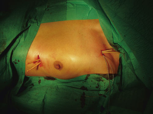 Figur 2  Ett eller to urinkatetre trekkes fra innstikket infraklavikul&aelig;rt til lomme nedenfor mamma