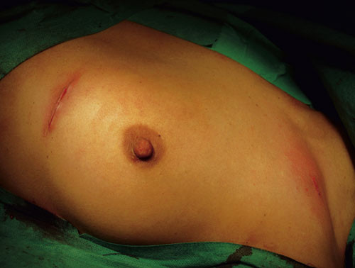 Figur 3  Innstikkssted og pacemakerlomme lukkes med intrakutan sutur