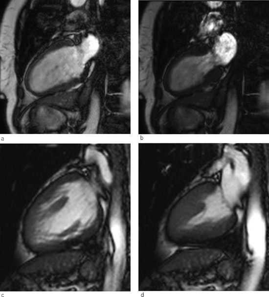 Figur 2  MR-unders&oslash;kelse av hjertet (tokammersekvens) i a) diastole og b) systole er tatt dag 3, og viser fortsatt apikal&hellip;