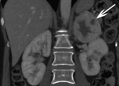 Figur 3  Abdominal CT rekonstruert i koronalplan viser en stor kontrastoppladende tumor med sentral nekrose utg&aring;ende fra&hellip;
