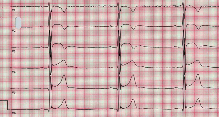 Figur 4  EKG (50 mm/s) med prekordialavledningene registrert hos friidrettsut&oslash;ver med langdistansel&oslash;ping som favorittgren