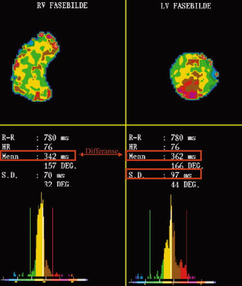 Figur 2 Fasebilde med tilh&oslash;rende verdier og histogram for hhv. h&oslash;yre ventrikkel (RV) og venstre ventrikkel (LV). Fasebildet&hellip;