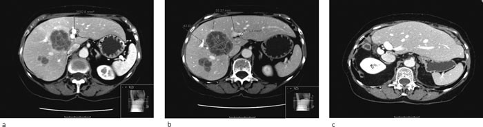 Figur 4  a) CT lever viser metastasering til lever. Pasienten er tidligere operert for cancer coli. b) Portvenembolisering&hellip;