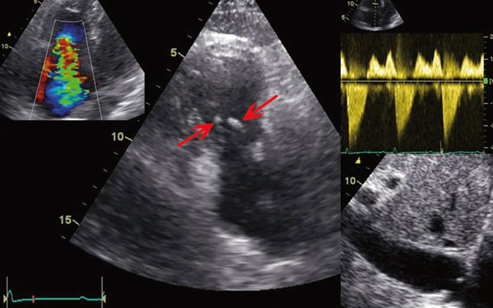 Figur 3 Fargedoppler av stor trikuspidalinsuffisiens. Trikuspidalklaff med fortykkede, forkortede, lite mobile seil som st&aring;r&hellip;