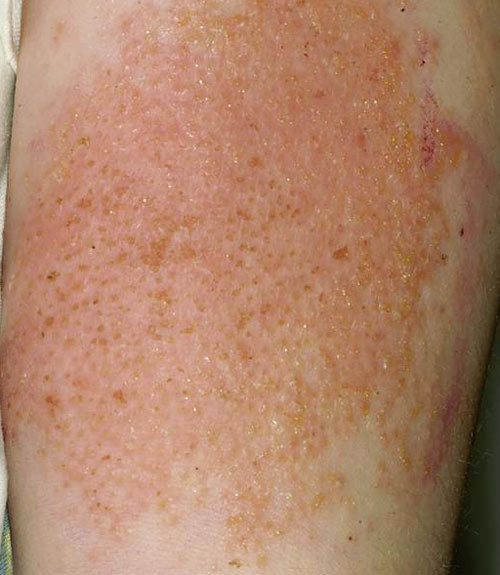 Figur 5  Pasient 2. V&aelig;skende dermatitt p&aring; overarm