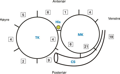 Figur 3  Lokalisering og antall atrioventrikul&aelig;re ledningsbaner i relasjon til mitral- og trikuspidalklaffer (MK og TK),&hellip;