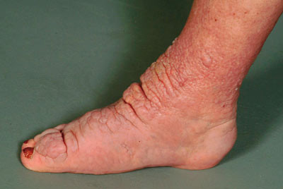 Figur 2  N&aelig;rbilde av figur 1. Blekrosa hud med papillomat&oslash;s overflate over t&aelig;r og fotrygg som danner tumorliknende lesjoner