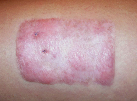 Figur 3  Thyreoideadermopati i transplantatomr&aring;det p&aring; venstre l&aring;r hos en kvinne i slutten av 30-&aring;rene