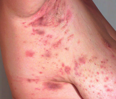 Figur 2  Moderat hidradenitis suppurativa med multiple inflammerte noduler og lett arrdanning (Hurleys grad 2)
