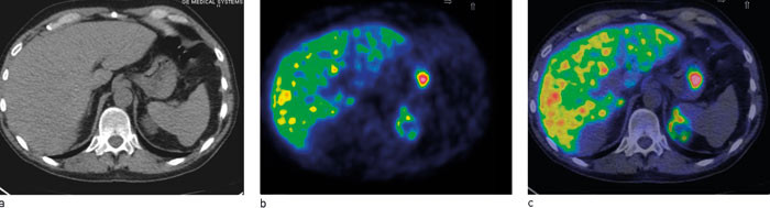 Figur 3  Metomidat-PET. a) PET, b) Lavdose CT, c) Fusjonert PET/CT. Pasient henvist for generell sykdomsf&oslash;lelse. Ved CT ble&hellip;