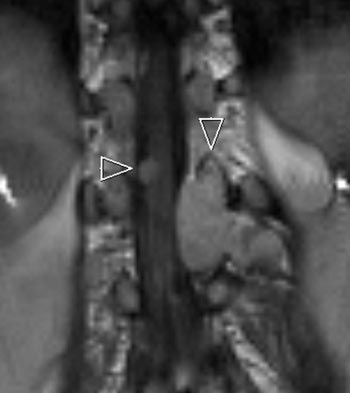 Figur 2  Sagittalt T1-vektet MR-bilde med kontrast viser sannsynlige schwannomer i spinalkanalen og i mellomvirvelhull &hellip;